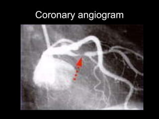 Coronary angiogram 
