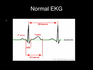 Normal EKG . P   wave 