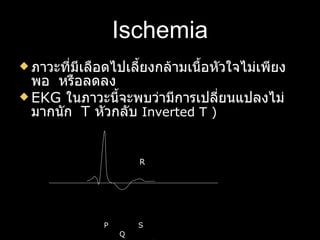 Ischemia ภาวะที่มีเลือดไปเลี้ยงกล้ามเนื้อหัวใจไม่เพียงพอ  หรือลดลง  EKG  ในภาวะนี้จะพบว่ามีการเปลี่ยนแปลงไม่มากนัก  T  หัวกลับ  Inverted T ) R P  S Q   T 