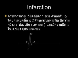 Infarction ภาวะการตาย  วินิจฉัยจาก  EKG   ด้วยคลื่น  Q   โดยจะพบคลื่น  Q   มีลักษณะเฉพาะคือ มีความกว้าง  1   ช่องเล็ก  (  .04 sec  )  และมีความลึก  1   ใน  3   ของ  QRS Complex R P  T S  Q  