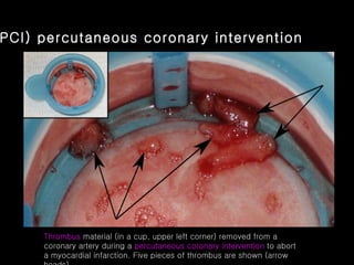 (PCI)   percutaneous coronary intervention Thrombus  material (in a cup, upper left corner) removed from a coronary artery during a  percutaneous coronary intervention  to abort a myocardial infarction. Five pieces of thrombus are shown (arrow heads)   