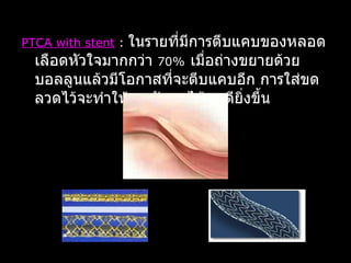 PTCA with stent  :  ในรายที่มีการตีบแคบของหลอดเลือดหัวใจมากกว่า  70%   เมื่อถ่างขยายด้วยบอลลูนแล้วมีโอกาสที่จะตีบแคบอีก การใส่ขดลวดไว้จะทำให้การรักษาได้ผลดียิ่งขึ้น 