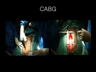 CABG 
