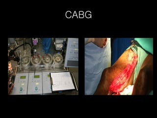 CABG 