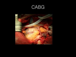 CABG 