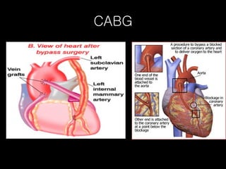 CABG 