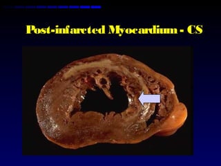 Post-infarcted Myocardium- CS
 