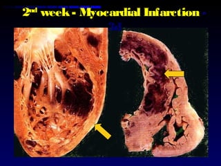 2nd
week- Myocardial Infarction -
3d
 