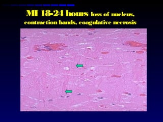MI 18-24 hours loss of nucleus,
contraction bands, coagulative necrosis
 