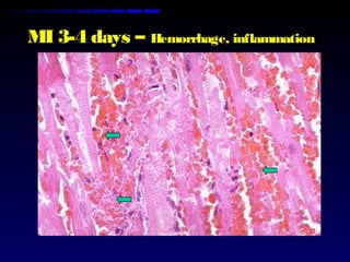 MI 3-4 days – Hemorrhage, inflammation
 