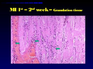 MI 1st
– 2nd
week– Granulation tissue
 