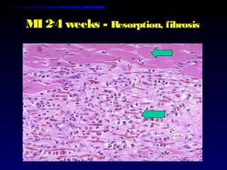 MI 2-
4 weeks - Resorption, fibrosis
 