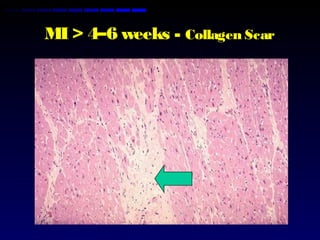 MI > 4–6 weeks - Collagen Scar
 