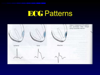 ECG Patterns
 