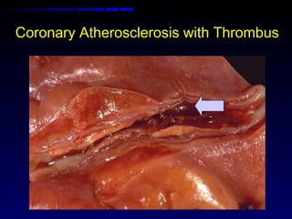 Coronary Atherosclerosis with Thrombus
 