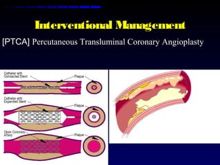 Interventional Management
[PTCA] Percutaneous Transluminal Coronary Angioplasty
 