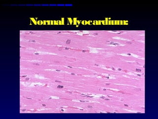Normal Myocardium:
 