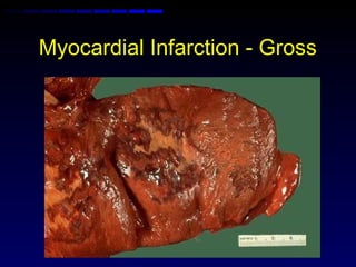 Myocardial Infarction - Gross
 