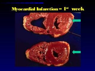 Myocardial Infarction – 1st
week
 
