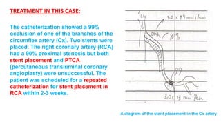 The catheterization showed a 99% 
occlusion of one of the branches of the 
circumflex artery (Cx). Two stents were 
placed. The right coronary artery (RCA) 
had a 90% proximal stenosis but both 
stent placement and PTCA 
(percutaneous transluminal coronary 
angioplasty) were unsuccessful. The 
patient was scheduled for a repeated 
catheterization for stent placement in 
RCA within 2-3 weeks. 
A diagram of the stent placement in the Cx artery 
TREATMENT IN THIS CASE: 
 
