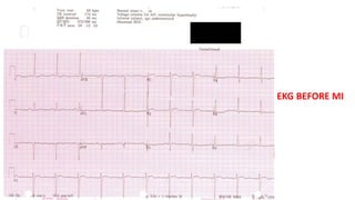 EKG BEFORE MI 
 
