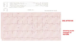 EKG AFTER MI 
showing acute 
changes of 
NSTEMI 
 