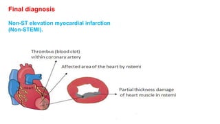 Final diagnosis 
Non-ST elevation myocardial infarction 
(Non-STEMI). 
 