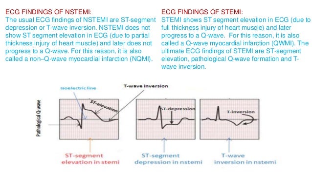 Acute MI - NSTEMI