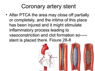 Coronary artery stent
• After PTCA the area may close off partially
or completely, and the intima of this place
has been injured and it might stimulate
inflammatory process leading to
vasoconstriction and clot formation so-----
stent is placed there. Figure 28-8
 