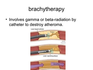 brachytherapy
• Involves gamma or beta-radiation by
catheter to destroy atheroma.
 