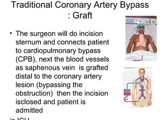 Traditional Coronary Artery Bypass
Graft:
• The surgeon will do incision
sternum and connects patient
to cardiopulmonary bypass
(CPB), next the blood vessels
as saphenous vein is grafted
distal to the coronary artery
lesion (bypassing the
obstruction) then the incision
isclosed and patient is
admitted
 