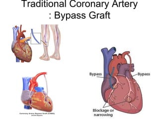 Traditional Coronary Artery
Bypass Graft:
 