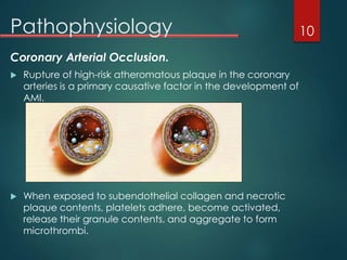 Pathophysiology
Coronary Arterial Occlusion.
 Rupture of high-risk atheromatous plaque in the coronary
arteries is a primary causative factor in the development of
AMI.
 When exposed to subendothelial collagen and necrotic
plaque contents, platelets adhere, become activated,
release their granule contents, and aggregate to form
microthrombi.
10
 