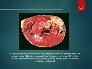 21
A transmural acute myocardial infarct, predominantly of the posterolateral left
ventricle (arrow). Note the myocardial hemorrhage at one edge of the infarct
that was associated with cardiac rupture, and the anterior scar (arrowhead),
indicative of old infarct.
 