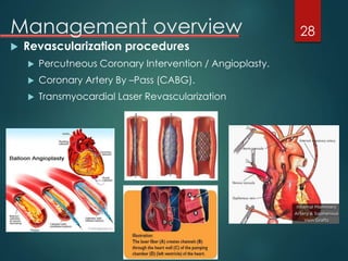 Management overview
 Revascularization procedures
 Percutneous Coronary Intervention / Angioplasty.
 Coronary Artery By –Pass (CABG).
 Transmyocardial Laser Revascularization
28
 