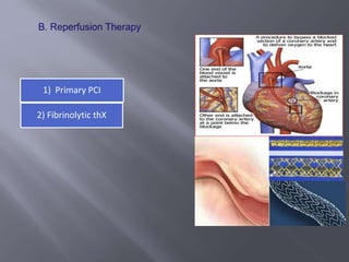 1) Primary PCI
2) Fibrinolytic thX
Drug eluting
stents
 