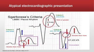 Atypical electrocardiographic presentation
Ibanez B, et al. Eur Heart J. 2018 Jan 7;39(2):119-177.
 