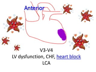 V3-V4
LV dysfunction, CHF, heart block
LCA
 
