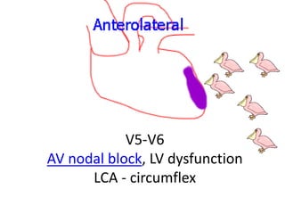 V5-V6
AV nodal block, LV dysfunction
LCA - circumflex
 