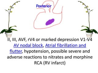 II, III, AVF, rV4 or marked depression V1-V4
AV nodal block, Atrial fibrillation and
flutter, hypotension, possible severe and
adverse reactions to nitrates and morphine
RCA (RV infarct)
 