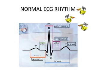 NORMAL ECG RHYTHM
 