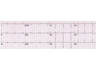 Acute miocardium infarction
