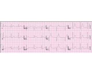Acute miocardium infarction
