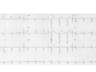 Acute miocardium infarction