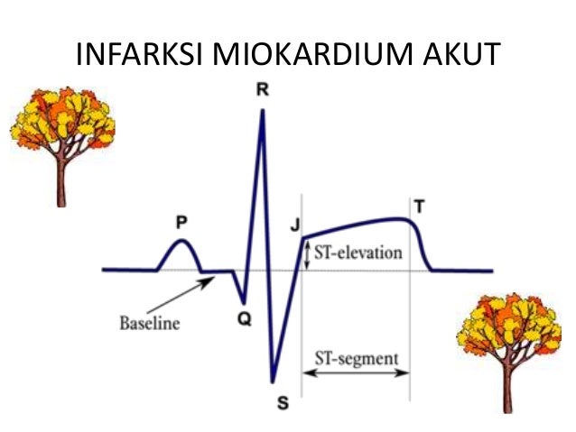 Acute miocardium infarction