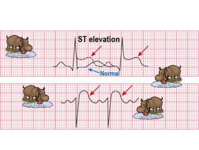 Acute miocardium infarction