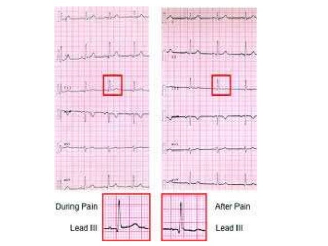 Acute miocardium infarction