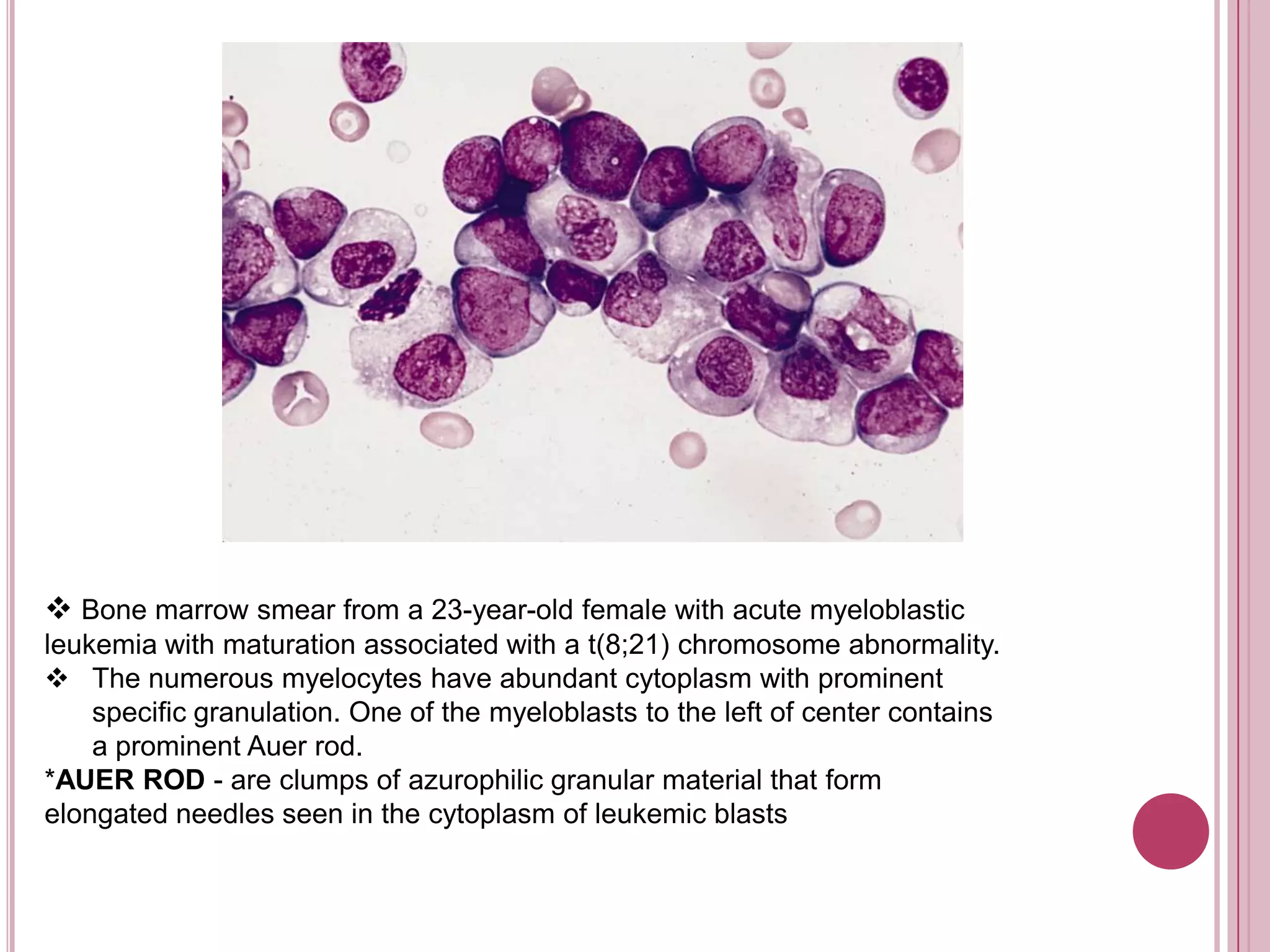  Bone marrow smear from a 23-year-old female with acute myeloblastic
leukemia with maturation associated with a t(8;21) chromosome abnormality.
 The numerous myelocytes have abundant cytoplasm with prominent
    specific granulation. One of the myeloblasts to the left of center contains
    a prominent Auer rod.
*AUER ROD - are clumps of azurophilic granular material that form
elongated needles seen in the cytoplasm of leukemic blasts
 