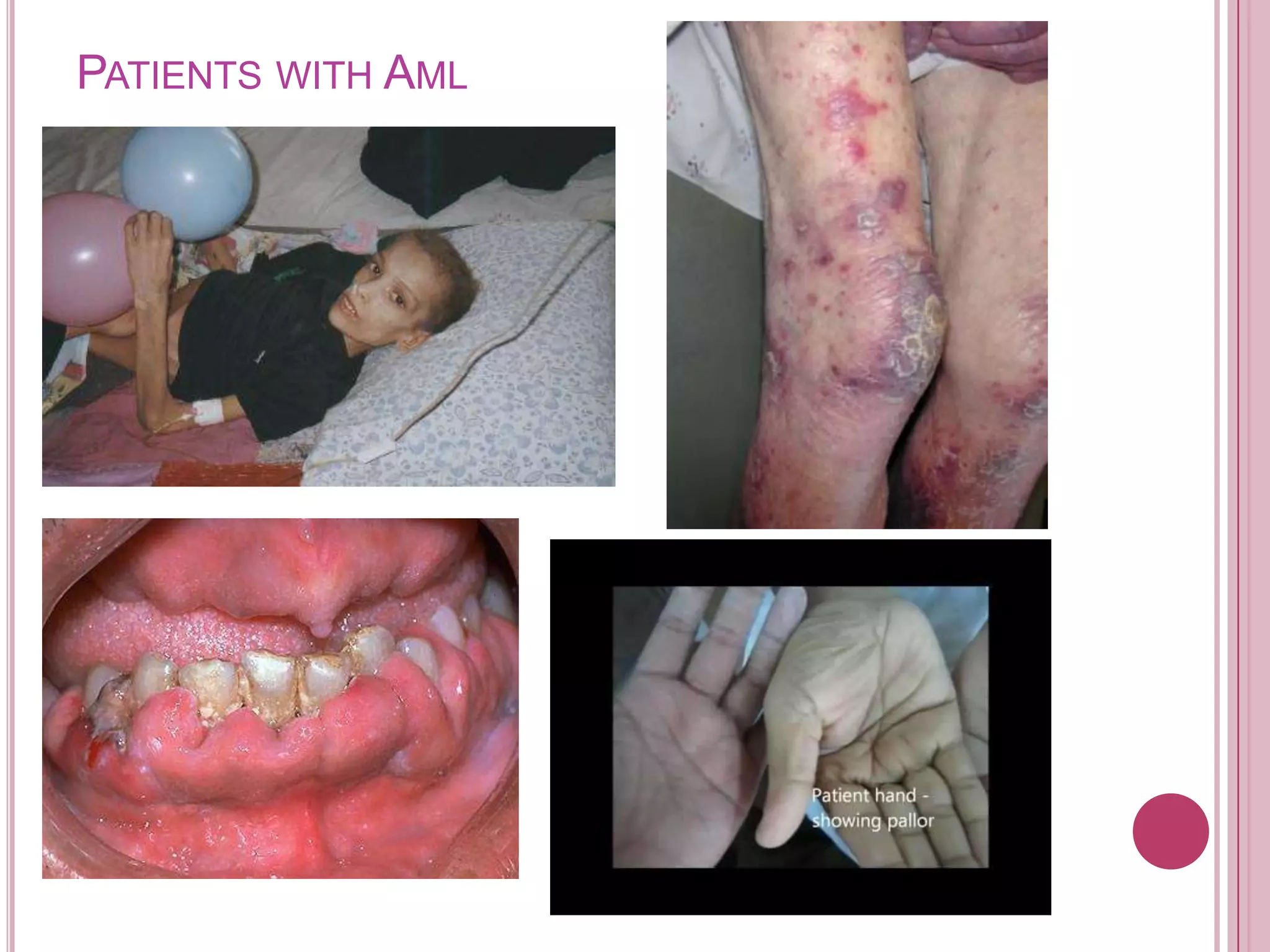 PATIENTS WITH AML
 