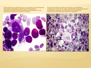 BMA SHOWS BOTH GRANULOCYTIC AND MONOCYTIC COMPONENTS
WITH MANY ABNORMAL EOSINOPHILIC PRECURSORS.
EOSINOPHILIC PRECURSORS SHOWS BOTH EOSINOPHILIC AND
BASOPHILIC GRANULES SHOWN BY ARROW
BM TREPHINE BIOPSY SHOWS HYPERCELLULAR MARROW
COMPOSED OF SHEETS OF LARGE BLASTS WITH VESICULAR NUCLEI
& MODERATE AMOUNT OF CYTOPLASM WITH NUMEROUS
EOSINOPHILIC PRECURSORS SHOWN BY ARROWS
 